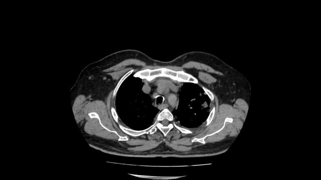 CT Thorax Cross Section for Mediastinal Lymph Node and Lung Nodule Assessment