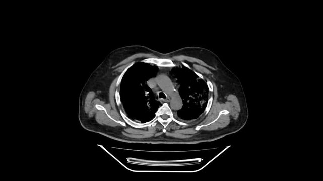 Axial HRCT Scan View of Thorax Showing Trachea Mediastinum and Upper Lung Parenchyma