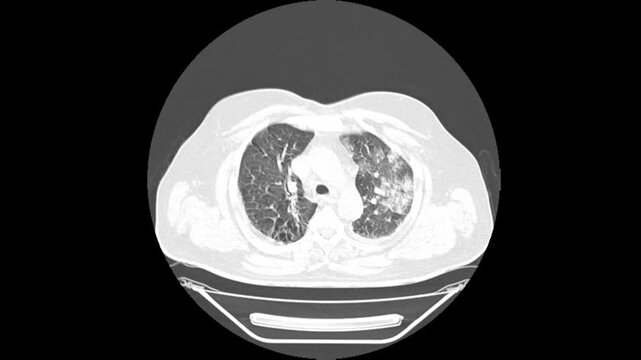 Coronal CT Thorax Scan for Ground Glass Opacity and Pulmonary Infiltration Screening