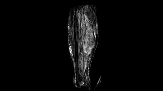 Coronal MRI Scan of Human Lower Legs Showing Tibia Fibula Calf Muscles and Soft Tissue Structure