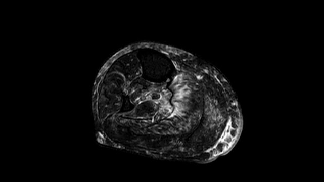 Academic 3D MRI Visualization of Lower Leg Cross-Section and Tibia Fibula Skeletal Architecture