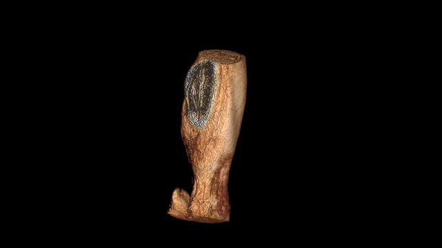 T2 Weighted MRI Scan Loop of Lower Leg Muscles for Calf Strain and Sports Injury Assessment