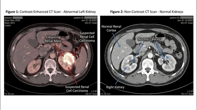 Medical CT scan of renal cell carcinoma, contrast-enhanced abdominal imaging showing abnormal kidney mass, diagnostic radiology comparison of normal kidneys