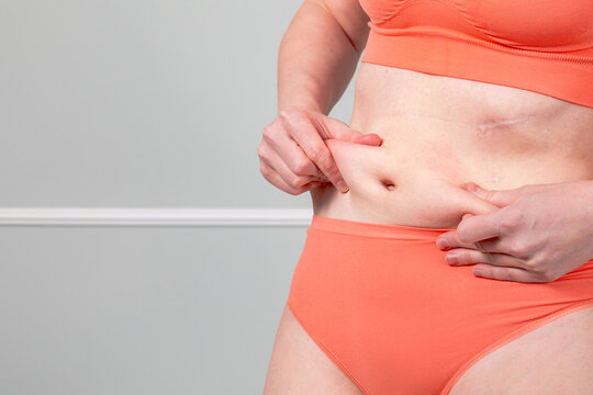 Woman holding belly fat fold with skin scar. Concept of postpartum body recovery, plastic surgery and weight loss transformation. Healthcare beauty treatment for abdominal skin texture