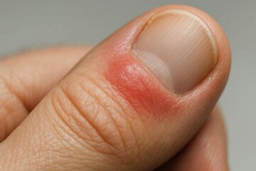 Fototapeta premium Red patch near fingernails