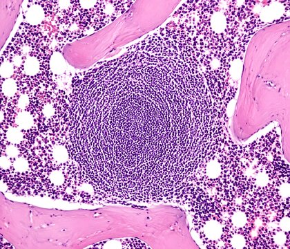 Bone marrow lymphoid aggregate positioned between trabeculae showing dense round nuclei and mixed surrounding cells