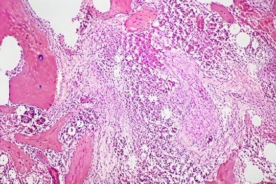 Bone marrow necrosis showing severely disrupted cellular architecture and pale damaged regions in pathology tissue