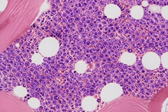 Bone Marrow Multiple Myeloma Pattern Featuring Plasma Cells Eccentric Nuclei Realistic Histological Staining Microscopic Detail
