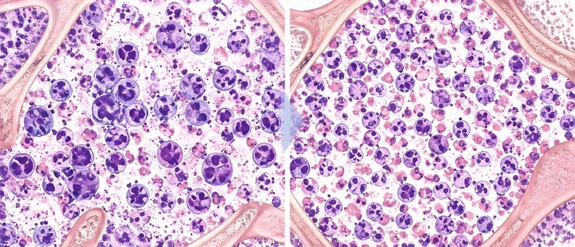 Bone marrow recovery process showing returning normal cell diversity and reduced abnormal clusters in histology