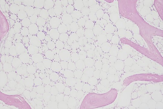 Bone marrow aplastic anemia pattern showing extensive fatty replacement and sparse hematopoietic cells pathology illustration