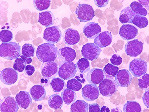 Bone Marrow Acute Myeloid Leukemia Pattern Abundant Myeloblasts Sparse Mature Cells Scientific Illustration Accurate Detail
