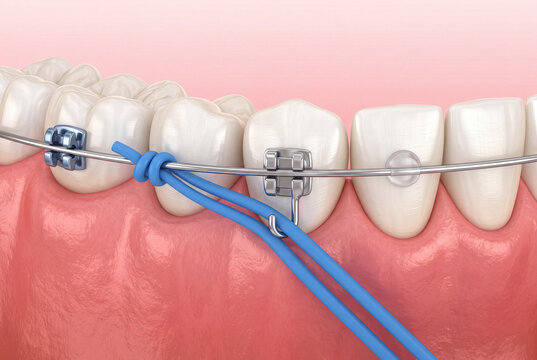 Orthodontic Braces Close-Up Showing Metal Brackets, Archwire, and Blue Elastic Ligatures on Human Teeth for Dental Correction and Clinical Education