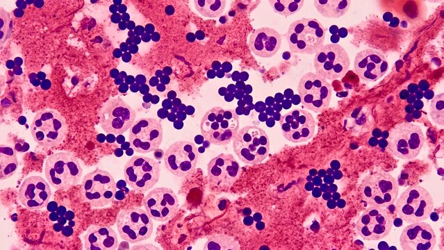 Staphylococcus aureus bacteria with neutrophils in Gram stained microscopic view