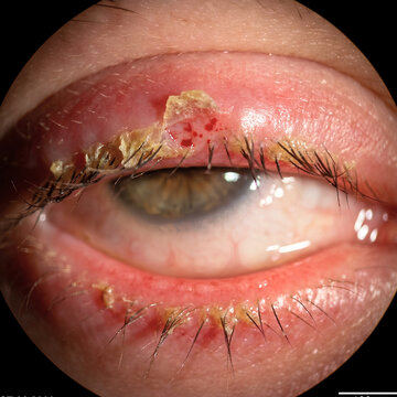 Clinical Slit Lamp Microscopy of Anterior Blepharitis with Crusting and Eyelid Inflammation