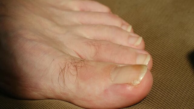 Close up male foot showing long dirty yellowed toenails possibly indicating fungal infection, lack of pedicure care resting on brown surface with visible hair on toes. Man foot with unhealthy toenails