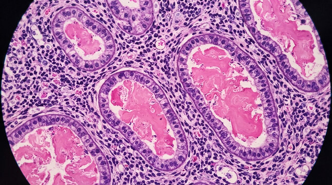 A high-magnification photomicrograph reveals thyroid follicles filled with homogeneous colloid material surrounded by follicular epithelium and chronic inflammatory cell infiltration Isolated on