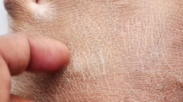 Close up on rough dry skin texture with fine cracks being touched by a finger
