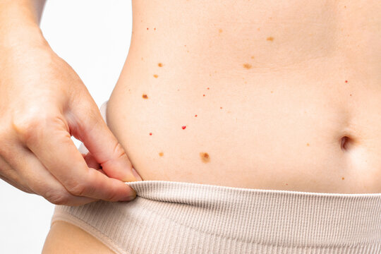 Woman checking moles on her abdomen skin. Skin cancer diagnostics concept. Close up of a female hand holding underwear while showing numerous moles, nevi and birthmarks on her belly skin.