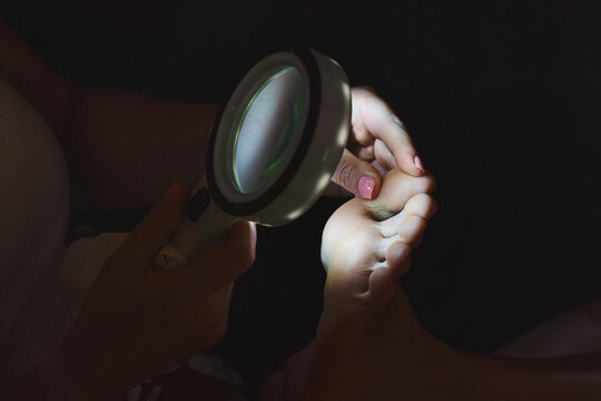 Dermatologist examining patient's fingernails for psoriasis