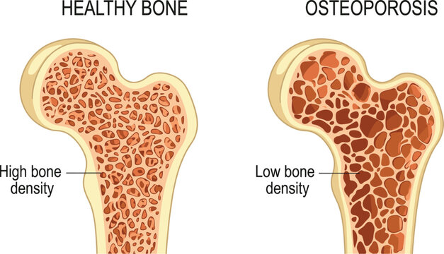 Medical vector illustration comparing healthy high density bone, and low density osteoporosis bone structure