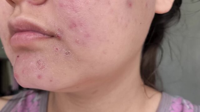 Acne and pimples on young woman's face, hormonal skin condition, dermatology, skincare treatment and adolescent health concept.
