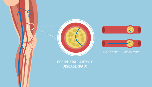 Peripheral artery disease infographic showing leg blood vessels, blocked artery with plaque buildup, and healthy vessel comparison.