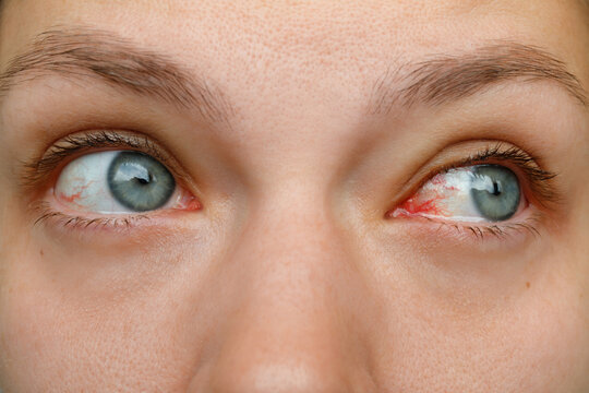 Close up of young woman look sideways showing red bloodshot eyes with burst blood vessel subconjunctival hemorrhage conjunctivitis symptom or irritation ophthalmology problem medical background