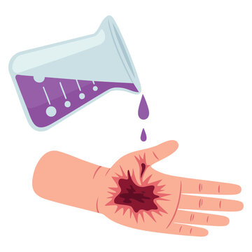 Medical illustration showing chemical burn caused by exposure to corrosive substances strong acid base oxidizer or cytotoxic agents
