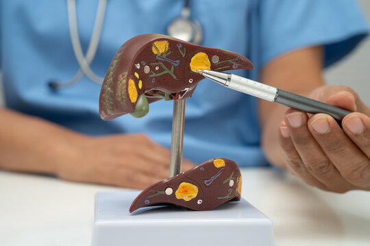 Cirrhosis, Liver cancer, fatty liver, Asian doctor with liver human anatomy model in World Hepatitis Day at hospital.