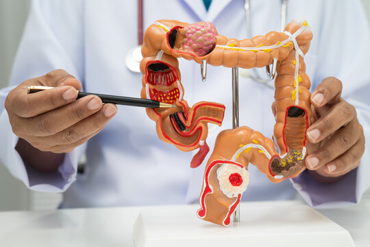 Colorectal cancer, doctor holding intestine colon human anatomy model.