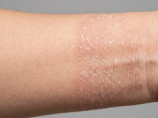 Fototapeta premium Close up of dry flaky skin on a person's wrist area.