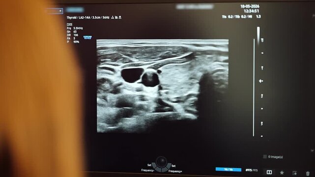 Medical ultrasound exam of the thyroid area shows details of the gland and surrounding tissues