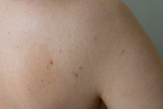 Problematic back skin with acne breakouts and inflamed pimples isolated photo, close-up of acne-prone skin for dermatology and skincare concepts