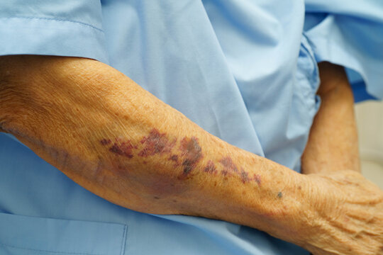 Ecchymosis, elderly bleeding on her arm after taking aspirin.