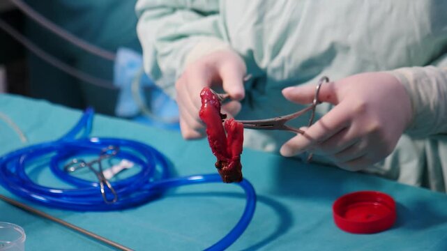 Surgeon gloved hands hold removed gallbladder with gallstones using forceps on blue drape. Perfect for medical education, hospital documentaries, Professional medical content. 4k video