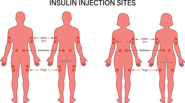 Insulin injection sites medical guide diagram vector featuring recommended body areas for diabetes treatment on male and female silhouettes.