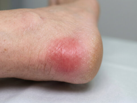 Woman foot with painful skin redness on heel. Inflammation, blister or pressure sore caused by uncomfortable shoe. Dermatological problem, foot care, medical condition and injury.