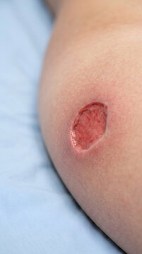 Close up of a painful open wound on human skin. Medical condition showing red flesh from an injury. Clinical examination of a lesion for recovery, dermatological treatment and health care.