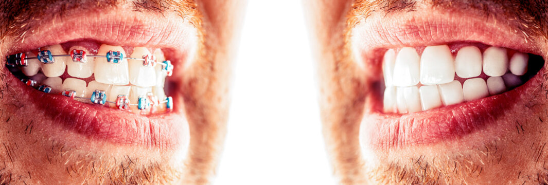Closeup man with teeth before and after braces treatment. Dental braces, correcting teeth