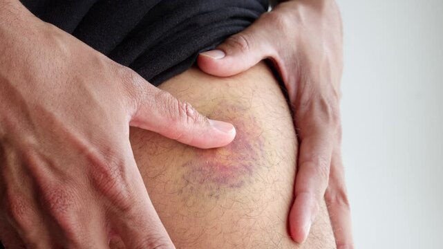 Man Touching His Thigh With Bruise (Contusion). - closeup shot