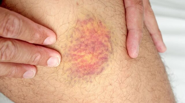 Reddish-purple Bruise - Contusion On Person's Skin. - closeup shot