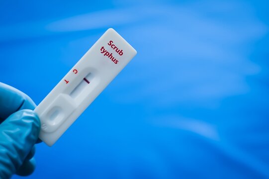 Blood  sample of patient negative result for scrub typhus.