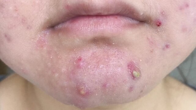acne and pustule on chin, hormonal skin condition, facial blemishes and skincare concept.