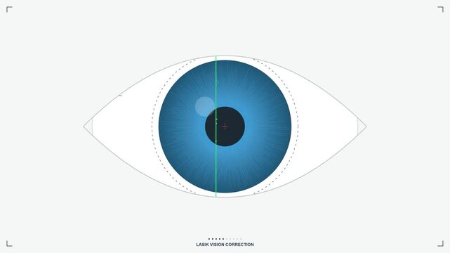 Laser Eye Surgery Animation for Vision Correction
