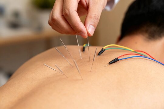 Acupuncture Treatment with Electroacupuncture on Back