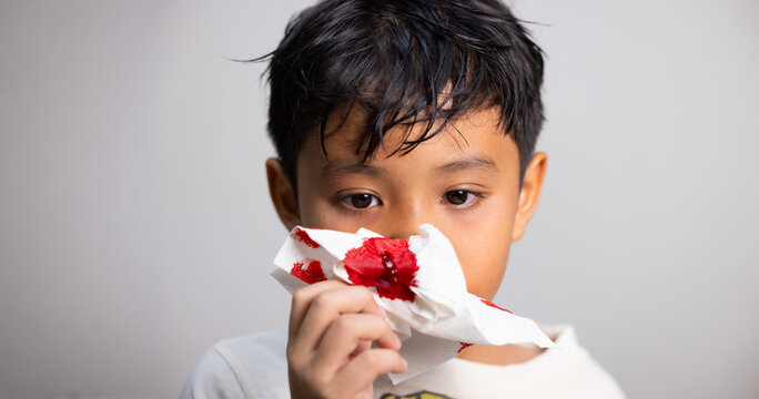 Nosebleed, Asian young Boy with bloody nose. Healthcare and medical. nose bleed