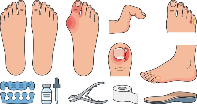 Bunion and Toe Care Medical Collection with Hallux Valgus Anatomy, Foot Pain Assessment, Orthotic Insoles, Toe Separator, and Podiatry Treatment Illustrations