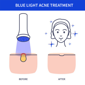 Blue light therapy outline acne face chart with skin comparison panels and blemishes. High-tech cosmetic care technology vector illustration.