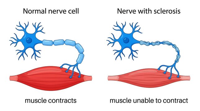 Comparison of normal nerve cell function and damaged nerve with sclerosis