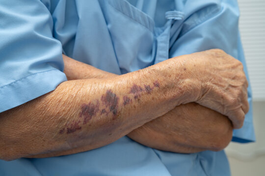 Ecchymosis, elderly bleeding on her arm after taking aspirin.